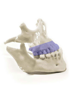 3D Printed Maxilla