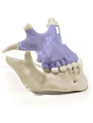3D Printed Maxilla (including zygomatic bone)