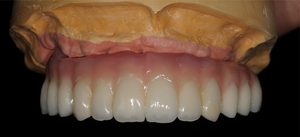 Full-Arch Implant Fixed Prosthesis