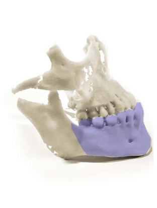 下顎3D模型